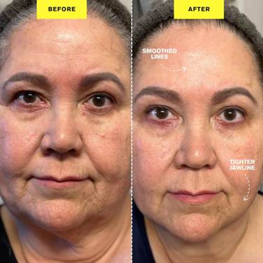 ZIIP Halo hyperpigmentation treatment